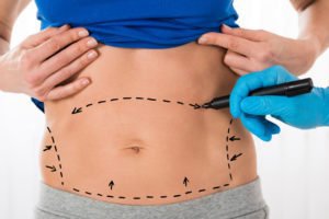 Tampa Tummy Tuck model being examined by a Plastic Surgeon in her abdomen