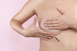 Tampa Breast Implants model showing excess skin in front of a pink background