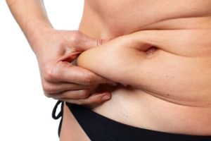 Tampa Body Contouring model after weight loss showing excess skin