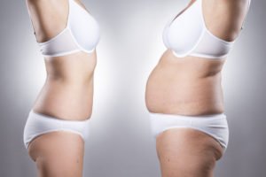 Tampa Liposuction before and after of a woman wearing white lingerie