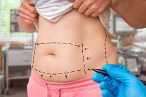 Tampa Body Contouring model getting examined by a plastic surgeon in her abdomen