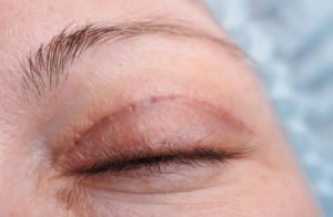 Tampa Blepharoplasty patient after surgery