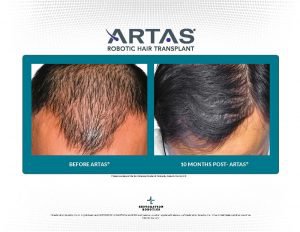 Tampa Robotic Hair Restoration before and after