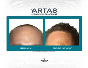 Tampa Hair Restoration patient before and after