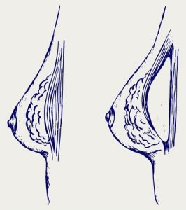 Tampa breast augmentation sketch before and after breast surgery