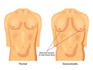 Tampa male breast reduction diagram