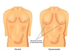 Are Male Breast Lumps Behind The Nipple A Sign Of Gynecomastia?