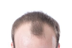 Tampa Hair Loss model with a receding hair line