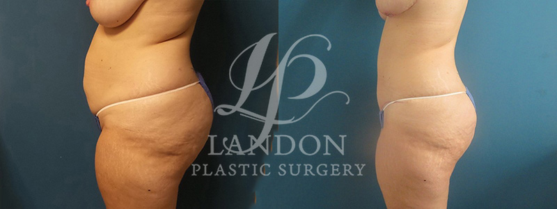 Tummy Tuck Before & After Image