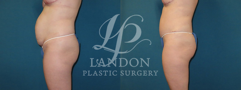Tummy Tuck Before & After Image