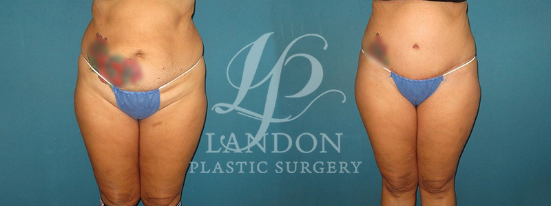 Tummy Tuck Before & After Image