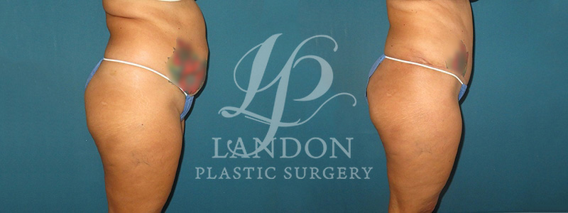Tummy Tuck Before & After Image