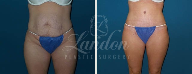 Tummy Tuck Before & After Image