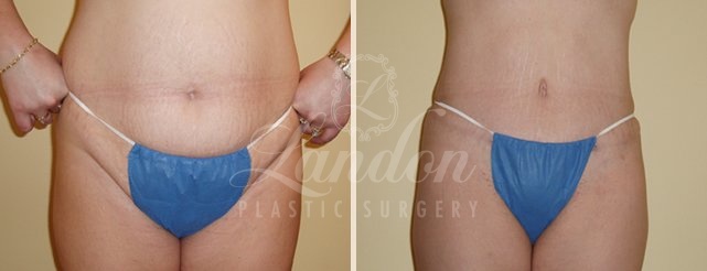 Tummy Tuck Before & After Image