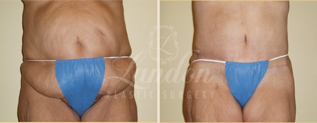 Tummy Tuck Before & After Image