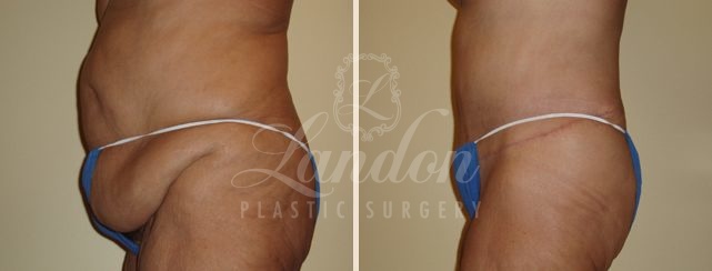 Tummy Tuck Before & After Image