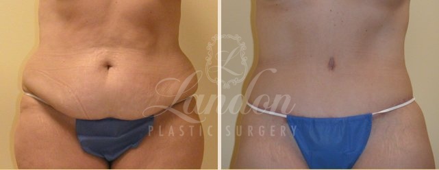 Tummy Tuck Before & After Image