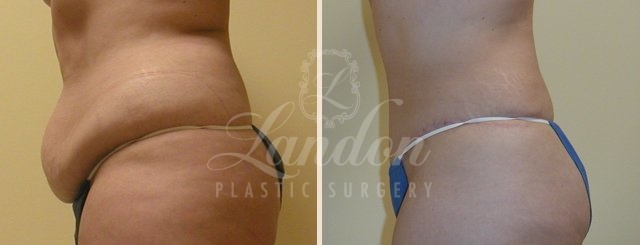 Tummy Tuck Before & After Image