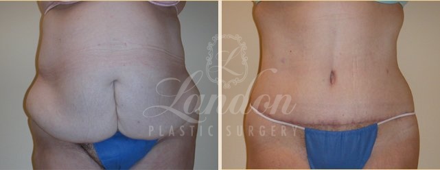 Tummy Tuck Before & After Image
