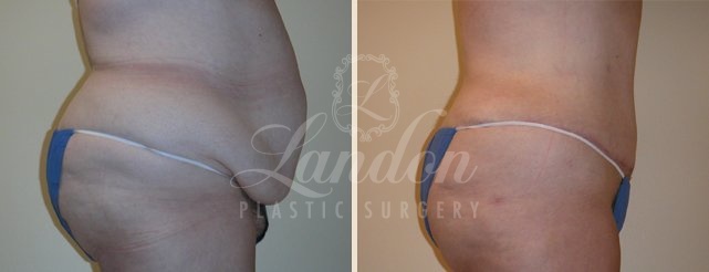 Tummy Tuck Before & After Image