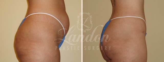 Tummy Tuck Before & After Image