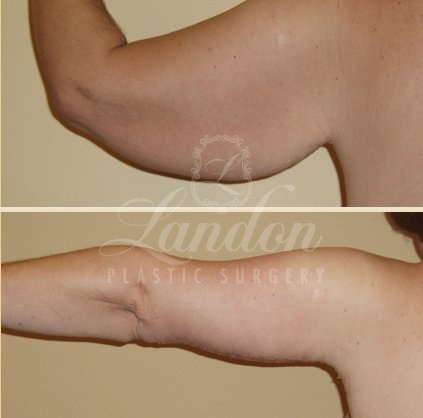 Arm Lift Before & After Image