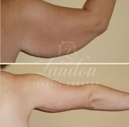 Arm Lift Before & After Image