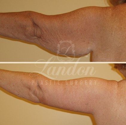 Arm Lift Before & After Image
