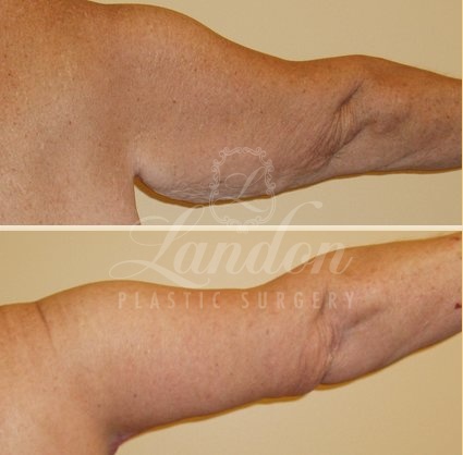 Arm Lift Before & After Image
