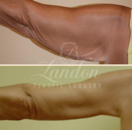 Arm Lift Before & After Image