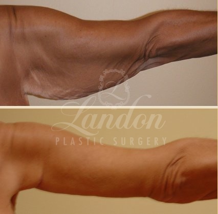 Arm Lift Before & After Image