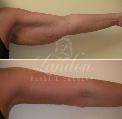 Arm Lift Before & After Image