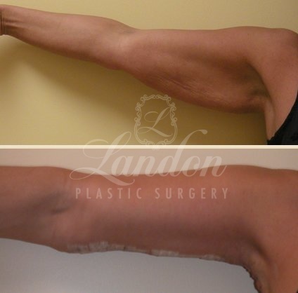 Arm Lift Before & After Image