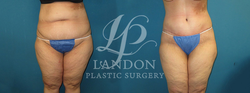 Liposuction Before & After Image