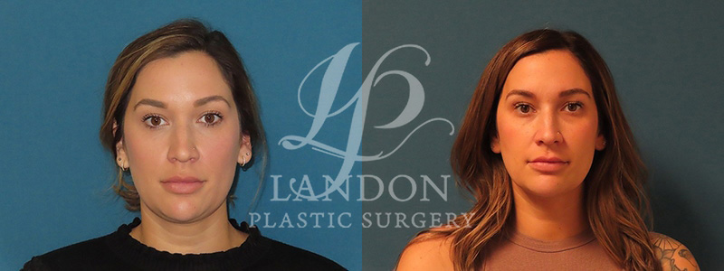 Liposuction Before & After Image