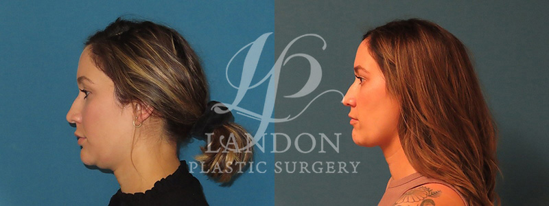 Liposuction Before & After Image