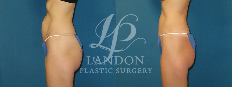 Liposuction Before & After Image