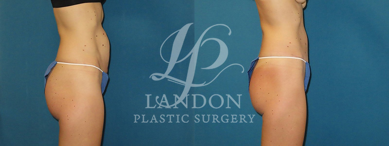 Liposuction Before & After Image