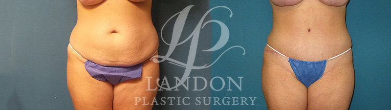 Liposuction Before & After Image