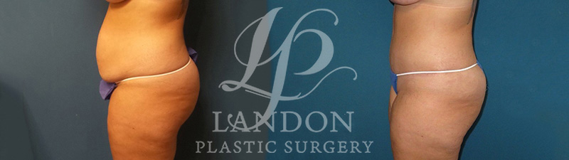 Liposuction Before & After Image