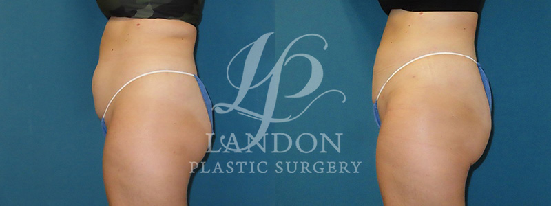 Liposuction Before & After Image