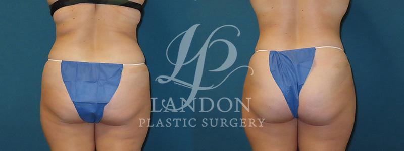 Liposuction Before & After Image