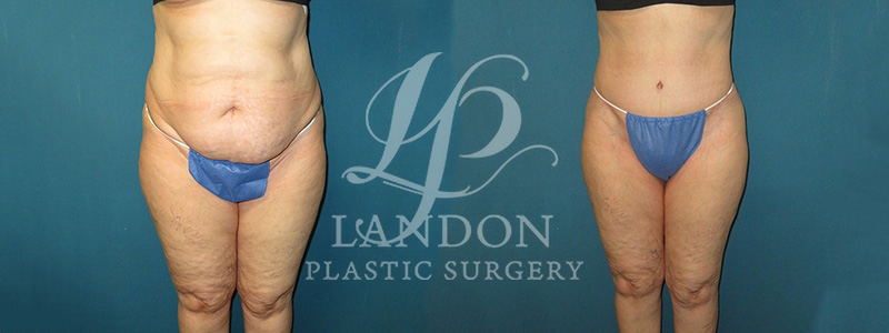 Liposuction Before & After Image