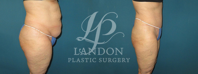 Liposuction Before & After Image