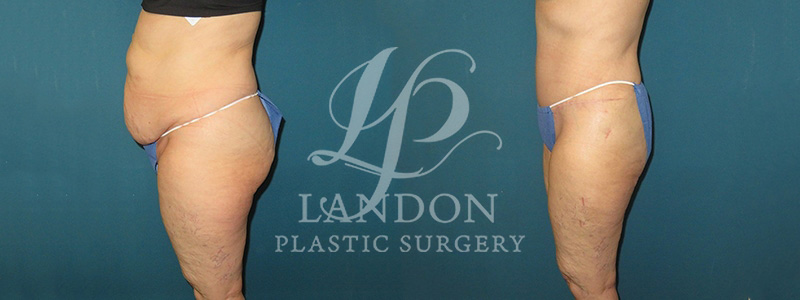 Liposuction Before & After Image