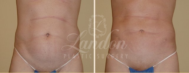Liposuction Before & After Image