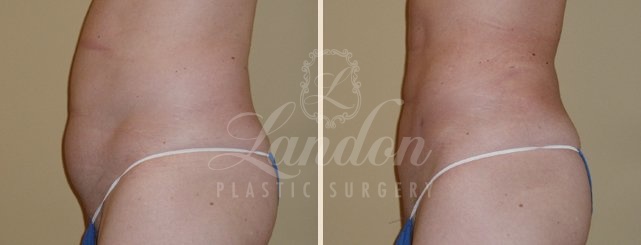 Liposuction Before & After Image