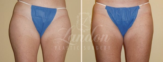 Liposuction Before & After Image