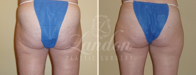 Liposuction Before & After Image