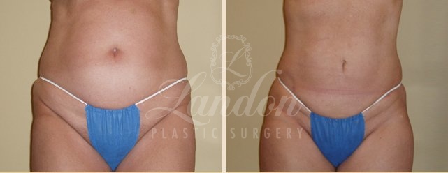 Liposuction Before & After Image